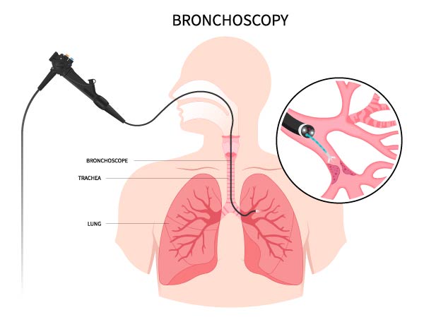 Bronchoscopy