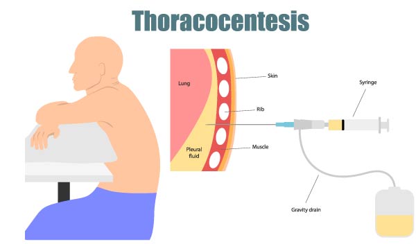 Thoracentesis